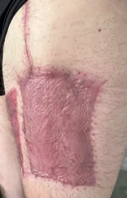 9-weeks-post-op-w-dr-assi-v0-4nakq61ps45f1.webp