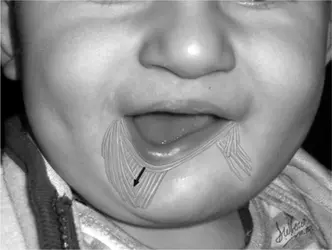 Asymmetric Crying Facies in the 22q11.2 Deletion Syndrome_ Implications for Future Screening.webp
