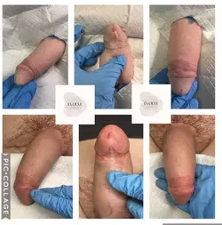 before-immediately-after-correcting-glans-with-tattoo-v0-c2lsanw3i16f1.webp