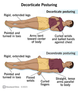 24969-decorticate-posturing.webp