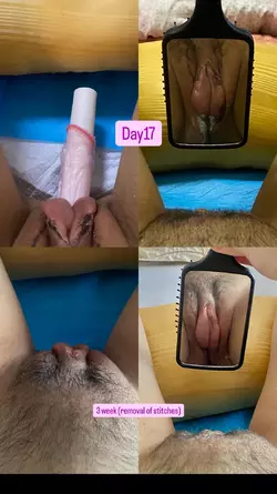 10-weeks-after-my-colon-vaginoplasty-with-dr-sutin-v0-54p5f1g85x6f1.webp
