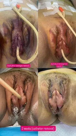 10-weeks-after-my-colon-vaginoplasty-with-dr-sutin-v0-913rf0g85x6f1.webp