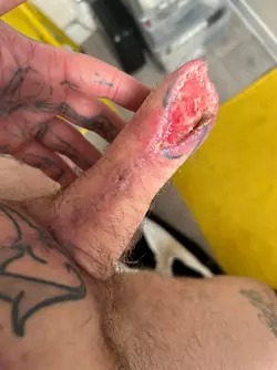 abdominal-phalloplasty-stage-1-uk-update-month-2-v0-fiykq2un5q5f1.webp