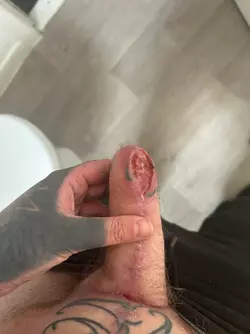 abdominal-phalloplasty-stage-1-uk-update-2-months-post-op-v0-msr4zqleqi6f1.webp