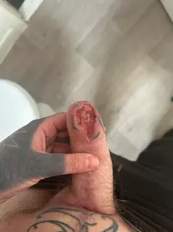 abdominal-phalloplasty-stage-1-uk-update-2-months-post-op-v0-fo24vrleqi6f1.webp