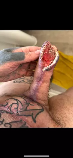 abdominal-phalloplasty-stage-1-uk-update-2-months-post-op-v0-hzz3uhleqi6f1.webp
