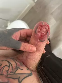 abdominal-phalloplasty-stage-1-uk-update-2-months-post-op-v0-55wahrleqi6f1.webp