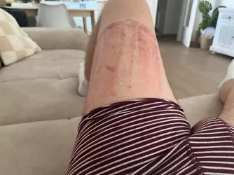 8-weeks-post-op-phallo-2-revision-surgeries-after-v0-sxtc76hho29f1.webp