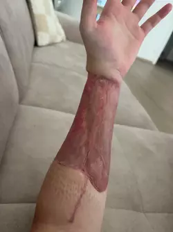 8-weeks-post-op-phallo-2-revision-surgeries-after-v0-043f61gho29f1.webp