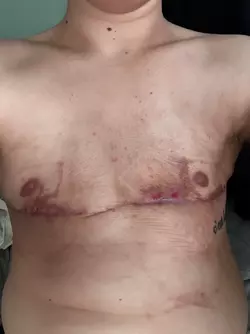 1-week-po-vs-9-weeks-po-theres-hope-even-with-skin-flap-v0-0a4fhpq4n59f1.webp
