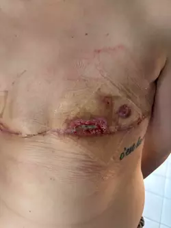 1-week-po-vs-9-weeks-po-theres-hope-even-with-skin-flap-v0-4ajjcuq4n59f1.webp