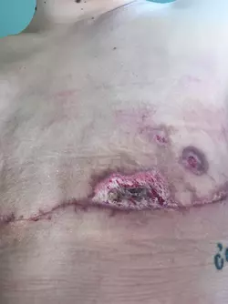 1-week-po-vs-9-weeks-po-theres-hope-even-with-skin-flap-v0-ek87soq4n59f1.webp