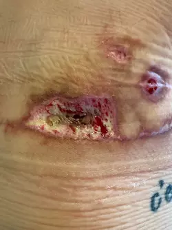 1-week-po-vs-9-weeks-po-theres-hope-even-with-skin-flap-v0-5uwzxoq4n59f1.webp