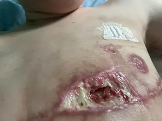 1-week-po-vs-9-weeks-po-theres-hope-even-with-skin-flap-v0-490sqoq4n59f1.webp