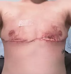 1-week-po-vs-9-weeks-po-theres-hope-even-with-skin-flap-v0-eui1ynq4n59f1.webp