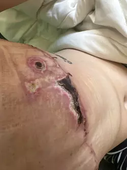 1-week-po-vs-9-weeks-po-theres-hope-even-with-skin-flap-v0-uvrfsxq4n59f1.webp