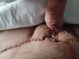 following-abdo-phalloplasty-3rd-stage-v0-meklz3x2oh9f1.webp