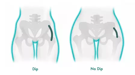 Hip-Dip-Infographic.webp