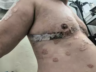 1-5-weeks-post-op-dr-ivan-hadad-v0-zq2cmrbphdaf1.webp