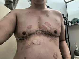 1-5-weeks-post-op-dr-ivan-hadad-v0-y6ck3y5phdaf1.webp