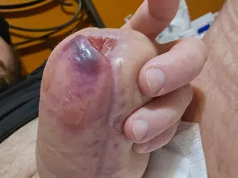 clinic-closed-and-penis-turning-blue-what-should-i-do-v0-r6jemld93abf1.webp