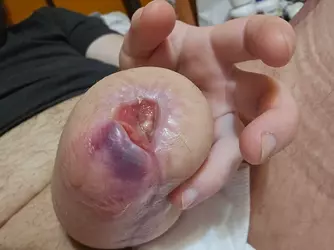 clinic-closed-and-penis-turning-blue-what-should-i-do-v0-qcw2ra793abf1.webp