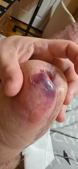 clinic-closed-and-penis-turning-blue-what-should-i-do-v0-kl3dovu83abf1.webp
