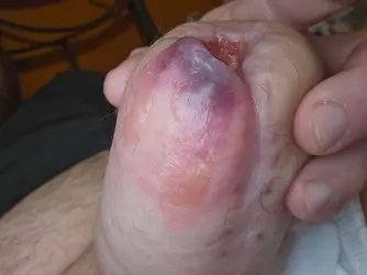 clinic-closed-and-penis-turning-blue-what-should-i-do-v0-3aebpdp83abf1.webp