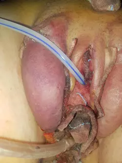swelling-4-days-post-srs-tw-graphic-v0-jk1fcx3qy4bf1.webp