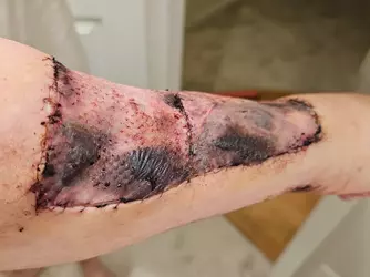 arm-1-week-post-op-v0-uxd2ps03zobf1.webp