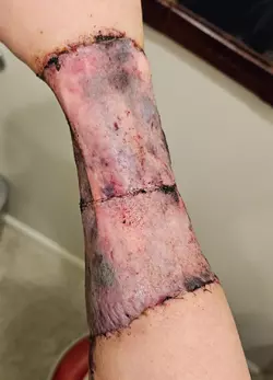 arm-1-week-post-op-v0-pzgcesx2zobf1.webp
