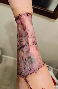 arm-1-week-post-op-v0-cbte26v2zobf1.webp
