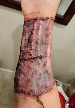 arm-1-week-post-op-v0-s6jvyjq2zobf1.webp