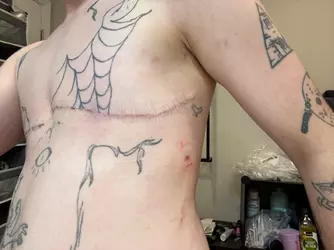 12-days-post-op-v0-0sglz0k4hdbf1.webp