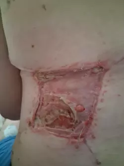 mld-donor-site-not-healing-properly-v0-93c8x545lpbf1.webp
