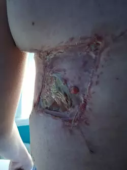 mld-donor-site-not-healing-properly-v0-x9bcmm05lpbf1.webp