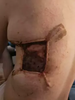 mld-donor-site-not-healing-properly-v0-ot75y5y4lpbf1.webp