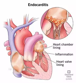 16957-indocarditis-illustration.webp