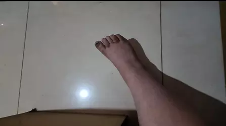 swollen leg and cankle.webp