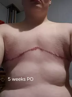 5-weeks-vs-4-weeks-vs-22-days-vs-2-weeks-vs-8-days-vs-pre-op-v0-d7by8qtbvqbf1.webp