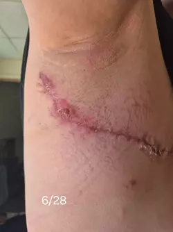 wound-separation-timeline-v0-mdll8wutxqbf1.webp