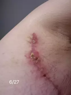 wound-separation-timeline-v0-6n1btjmtxqbf1.webp