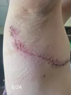 wound-separation-timeline-v0-mfc2mm9txqbf1.webp
