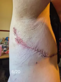 wound-separation-timeline-v0-qbpca5xsxqbf1.webp