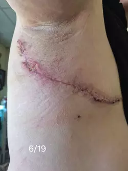 wound-separation-timeline-v0-7umyqyjsxqbf1.webp