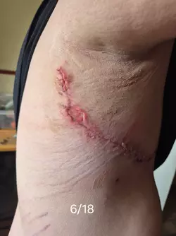 wound-separation-timeline-v0-7fr0bj7sxqbf1.webp