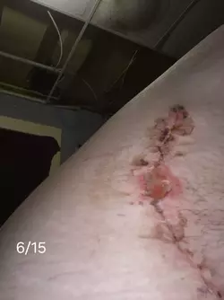 wound-separation-timeline-v0-dk7rp4zrxqbf1.webp
