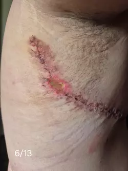 wound-separation-timeline-v0-aqnu61mrxqbf1.webp