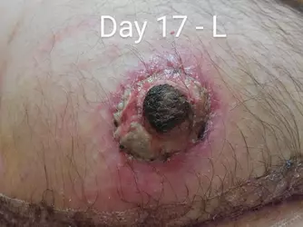 infected-nipples-v0-aj9u2nve6hcf1.webp