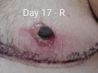 infected-nipples-v0-esgv0hre6hcf1.webp